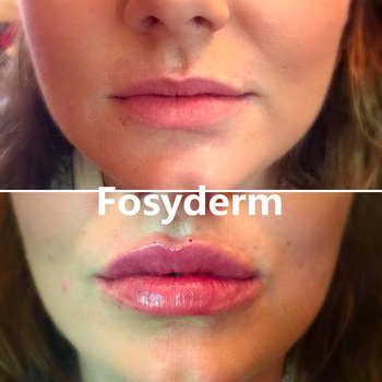 Hyaluronic Acid Injector Dermal Lip Fillers Injectable For Lip Enhancement Gel
