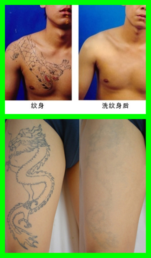Female Beauty Salon Portable Mini Q Switched Yag Laser For Hyperpigmentation