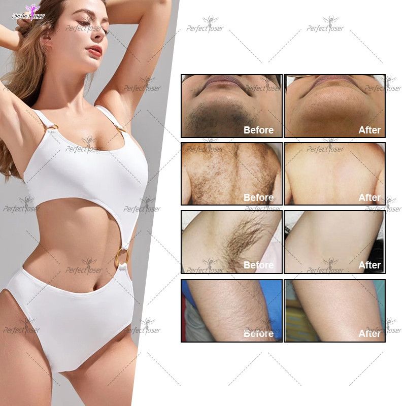 1064nm 810nm 808nm Diode Laser Hair Removal Machine 1200w