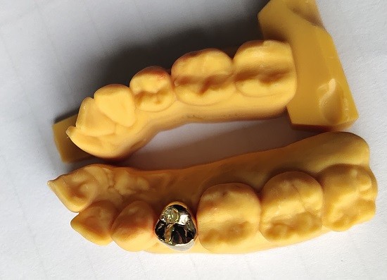 Good Fitness High Precious Gold Alloy Dental Crown