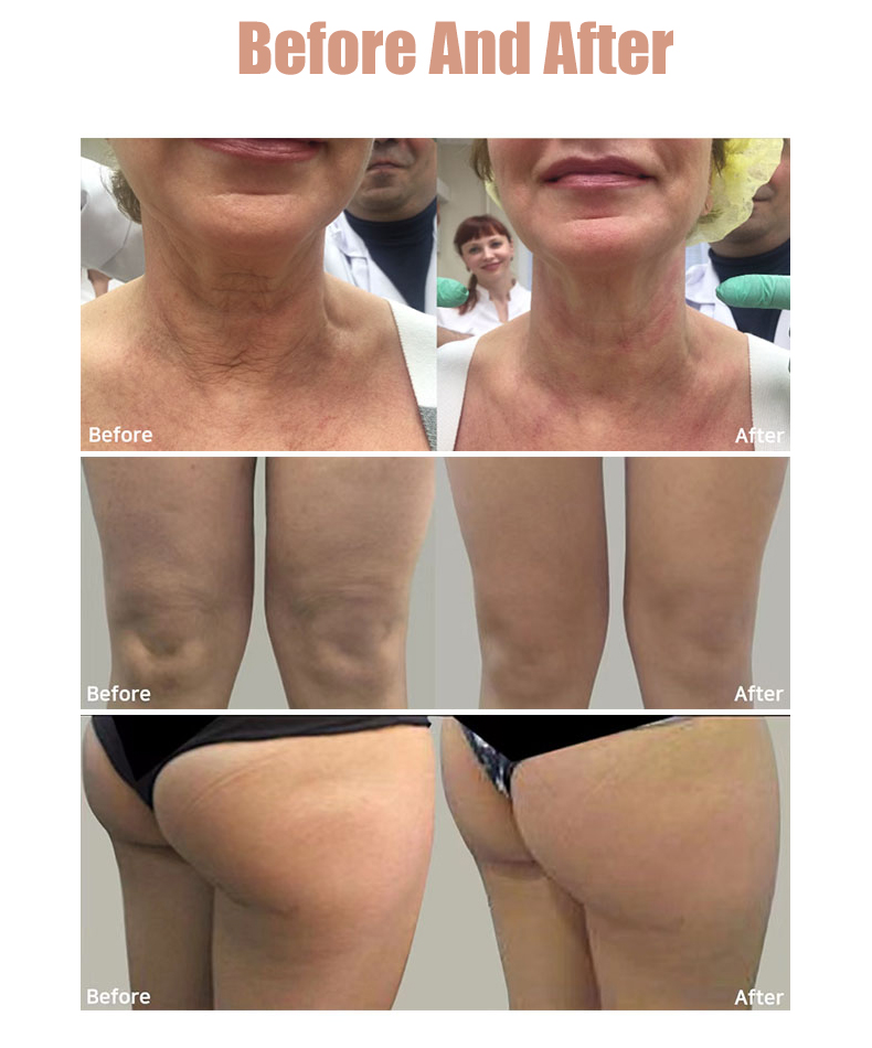 Manufacture vertical Hifu Rf Machine For Face Lifting Skin Tightening New Doublo HIFU Beauty Machine