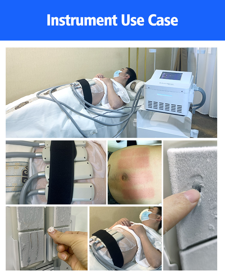 EMS Cooling Beauty Therapy Machine Fat And Cellulite Reduction Machine