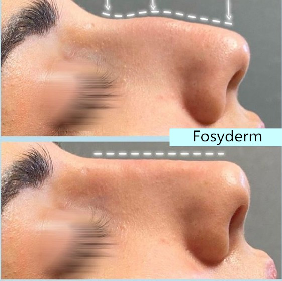 Fosyderm Deep Dermal Filler For Nose Chin HA Hyaluronic Acid