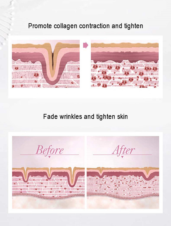 Skin Rejuvenation RF Beauty Instrument