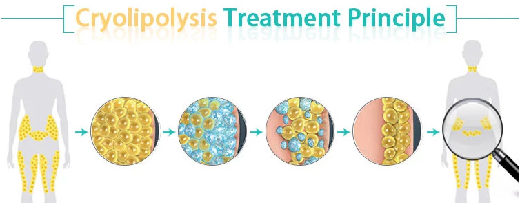 cryogenic treatment services cocoon beauty tighten cryolipolysis system cryo