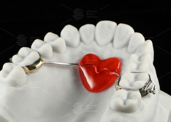 Stainless Steel Orthodontic Nance Appliance Horseshoe Design Orthodontic
