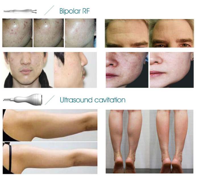 hot sale mini slimming machine with HIFU and RF and ultrasound cavitation technology for obesity cure and face lift