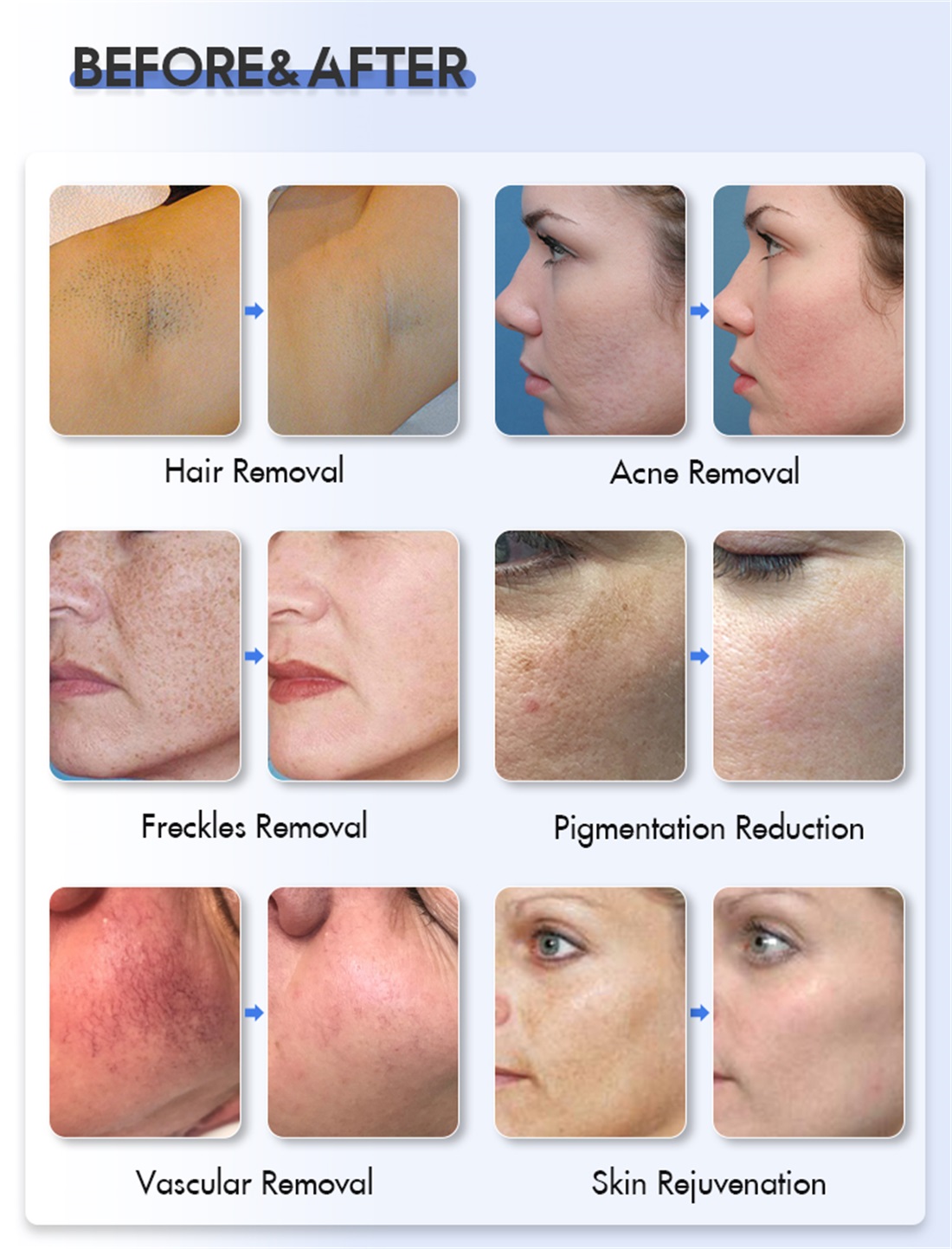 Multifunctional 3 in 1 DPL IPL OPT Permanent Laser Hair Removal Skin Rejuvenation/vascular removal machine