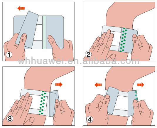 Medical IV cannula fixation transparent film dressing