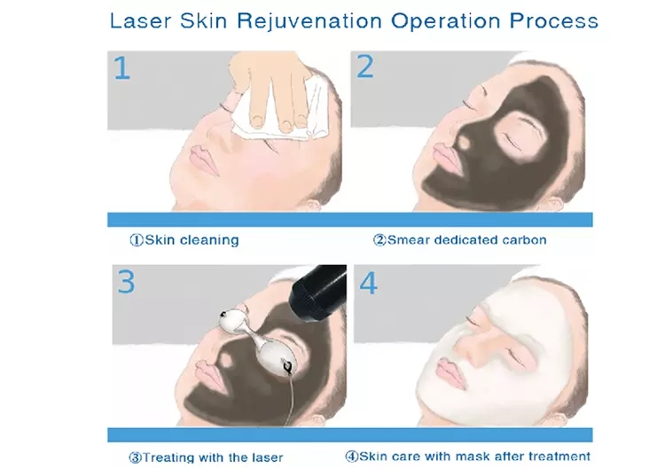 Skin Treatment Pico Laser Tattoo Removal Machine , 2000W Q Switch ND YAG Laser