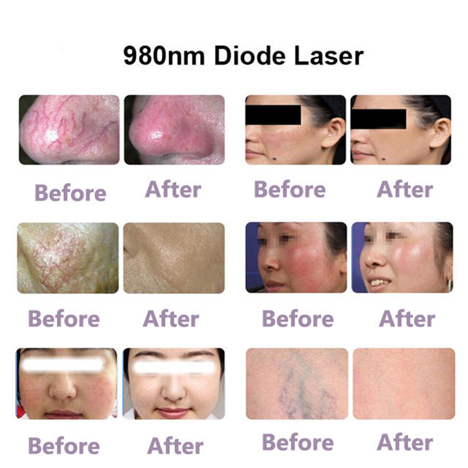 30W 100ms Spider Veins Removal Machine 980 Nm Diode Laser For Vascular Removal