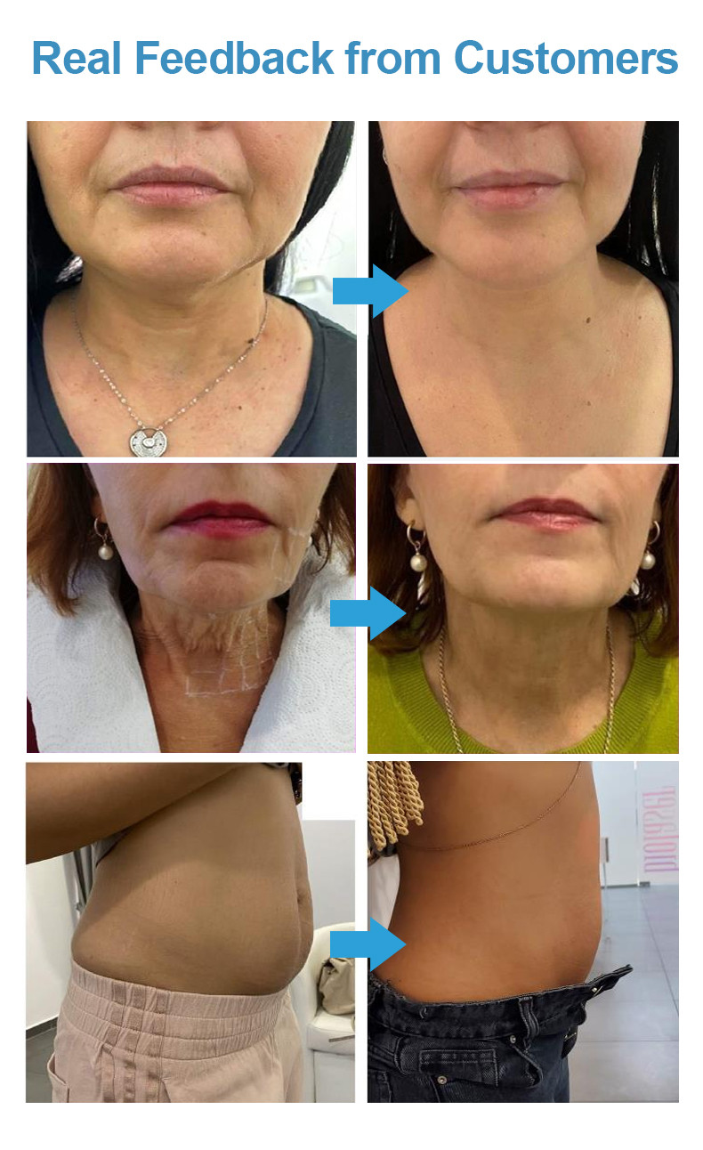 2023 Hot selling 7D Facial Lifting Anti-Wrinkle Beauty Salon Equipment