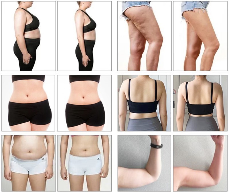 532nm 635nm Cold Laser Weight Loss Machine 10d Maxlipo Master