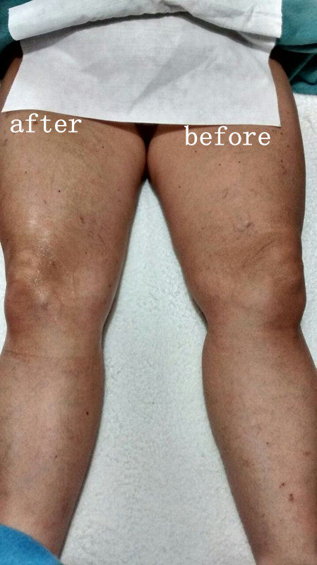 Skin Rejuvenation Machine Face Wrinkle Removal Machine Jowl lifting