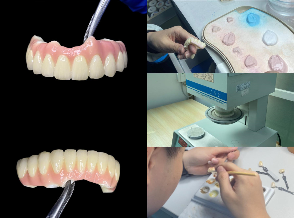 Dental Implant Crown with titanium abutment for Durable Tooth Restoration