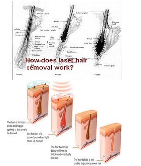 2000W High Power Laser Diode 808nm Hair Removal / 808nm Diode Laser Hair Removal Machine 12*20mm Big Spot SIze