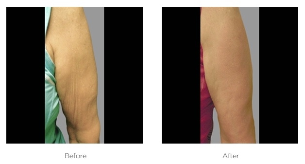 Elite Ultra 360_Before_and_After_Arm
