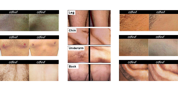 Pain Free Laser Hair Removal Equipment 808nm For Female