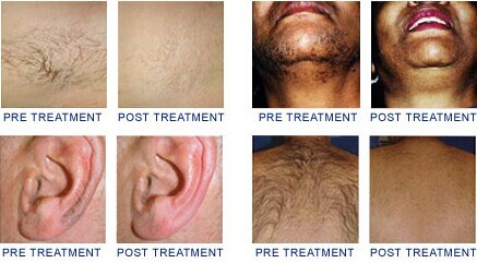 IPL hair removal machine skin rejuvenation machine intense pulsed light machine