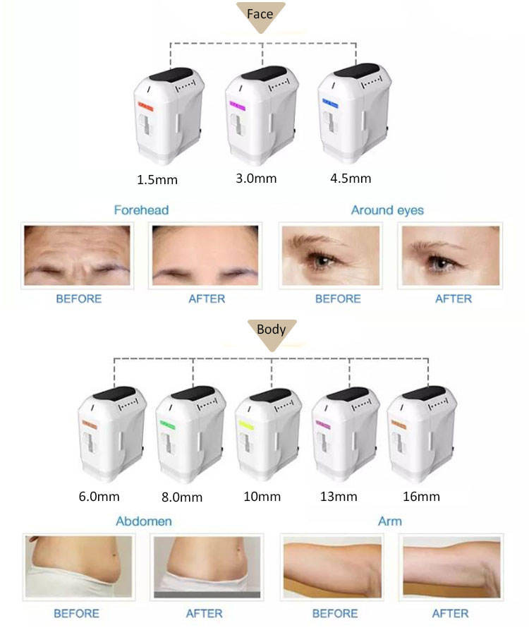 Microneedle Rf Fractional 4D HIFU Lifting Machine 10000 Shots Triple Handles