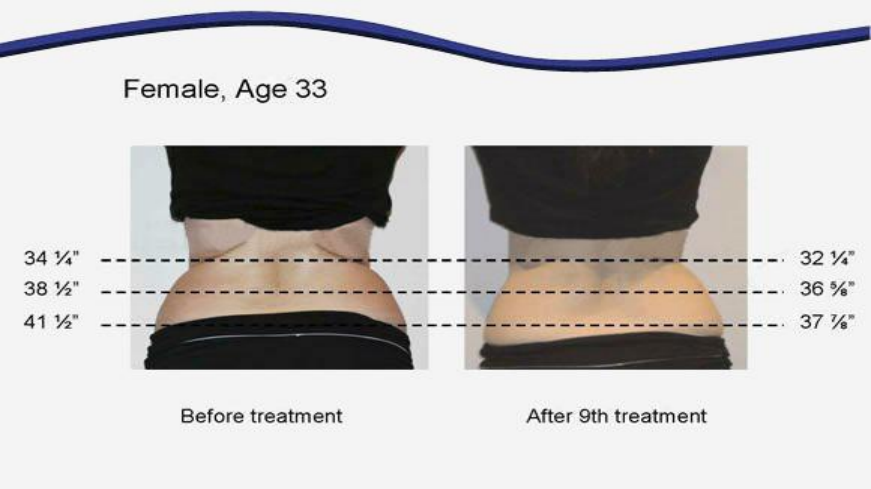 6 In 1 RF Lipolaser 80k Cavitation Weight Loss Rf 80k Cavitation Ultrasound Slimming Machine