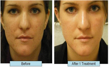 CO2 Laser Fractional Skin Resurfacing Treatment