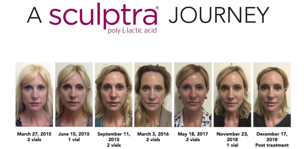 dermal fillerss in Calgary - long lasting cosmetic filler