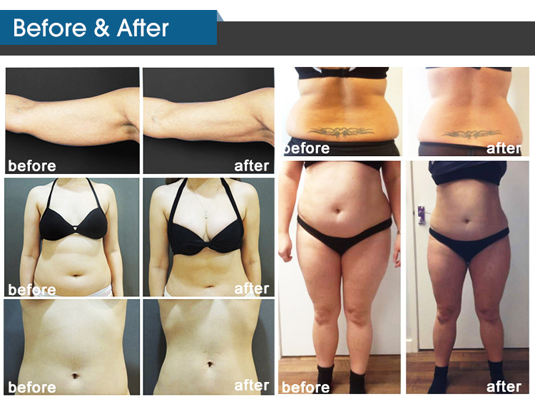 360 Fat Freezing Machine , Ultrasonic 40k Slimming Cavitation Machine