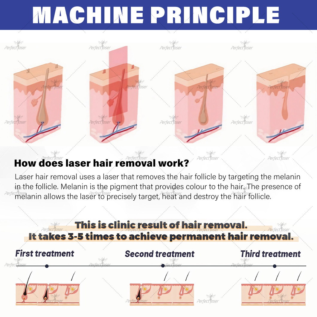 1600W Diode Laser Hair Removal Machine with 808nm Wavelength for Effective Treatment