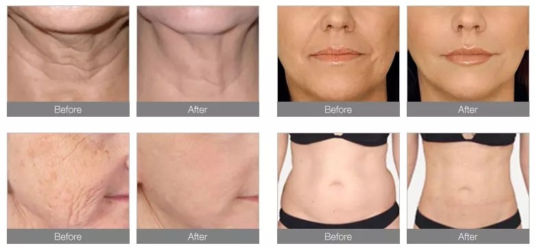 Doublo Gold Rf Hifu Anti Aging Face Lift Machine 9d 7d Hifu High Intensity Focused Ultrasound Machine