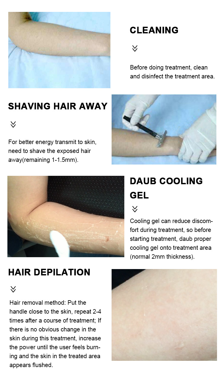 Portable 808nm Diode Laser Hair Removal Machine For Home