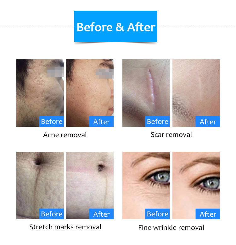 A6s Virtue RF Microneedling Machine Cryo Serum Microneedle Rf Fractional Portable
