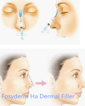 Hyaluronic Acid Injection Nose Dermal Filler , Hyaluronic Acid Gel Fillers