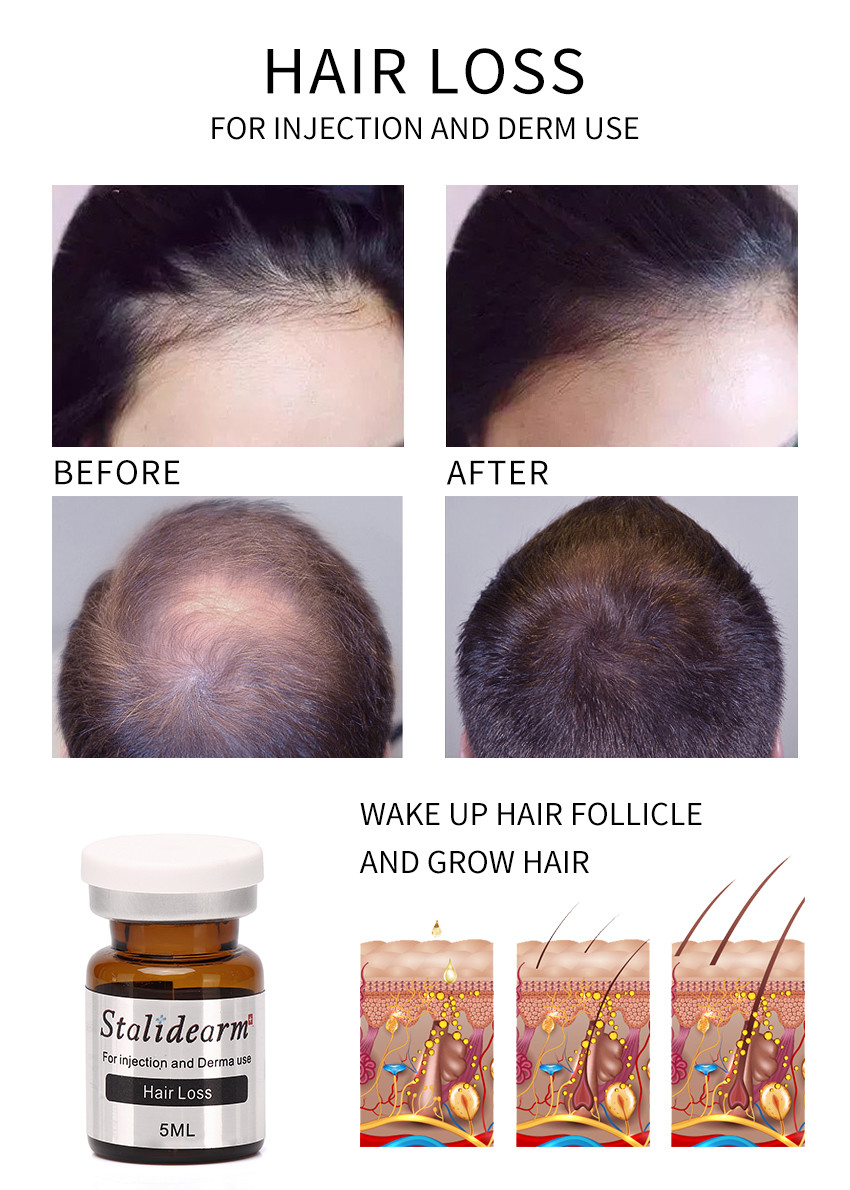 Stalidearm Brand Organic Serum Set Anti Hair Loss Fast Grow Anti Hair Fall Essence For Hair Growth Regrowth Serum