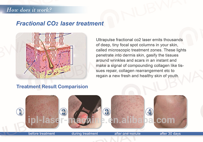 co2 laser vaginal.jpg