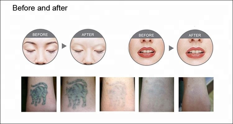 Portable Nd Yag Laser Tattoo Removal Machine Gray 2 Years Warranty