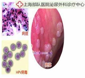 Clear Genital warts removal condyloma treatment herbal product for male sexually transmitted diseases