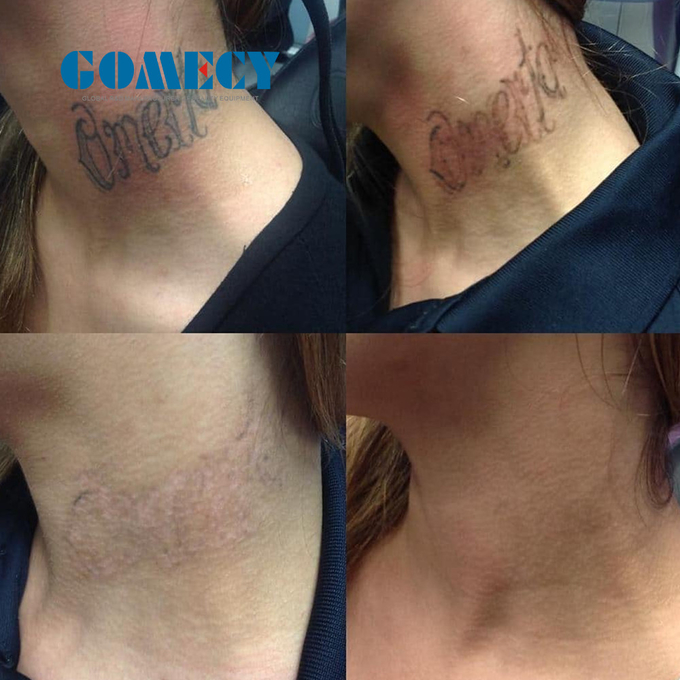 Q Switched ND Yag Laser Machine 2000W High Energy And 6 Functions 100-2000J For Remove Age Pigmented Birthmarks