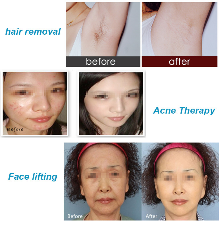 Skin Tightening Optical Ipl Hair Removal Machine 610nm Multi Pulse