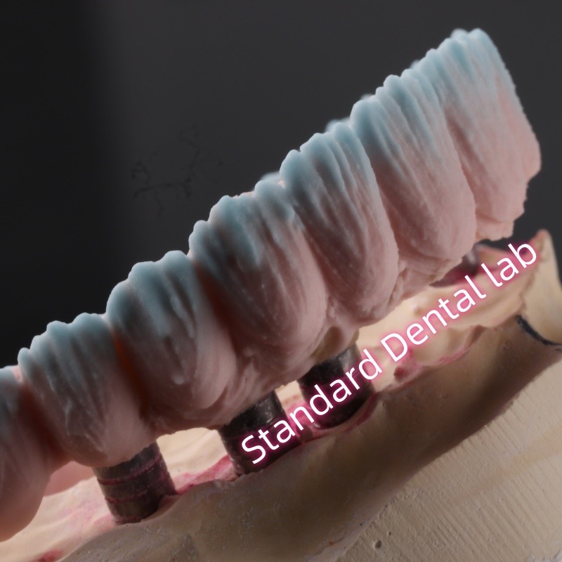 Zirconia Implant Bridge Screw Retained With Pink Gum Porcelain