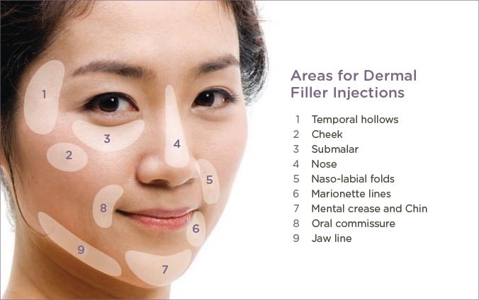 Cross Linked Hyaluronic Acid In Lip Fillers Dermal 1ml