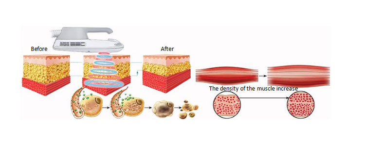 Skin Tightening Inner Ball Roller Machine
