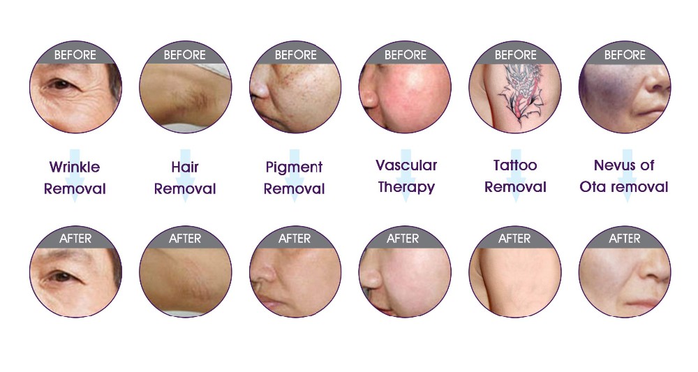 4 In 1 E Light IPL RF Beauty Equipment Permanent No Pain Tattoo Removal / Acne Removal