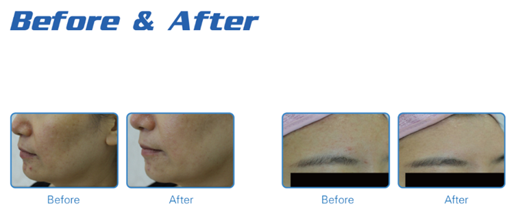 New arrival 5 handles hydro dermabrasion machine for skin whitening  acne treatment (1).png