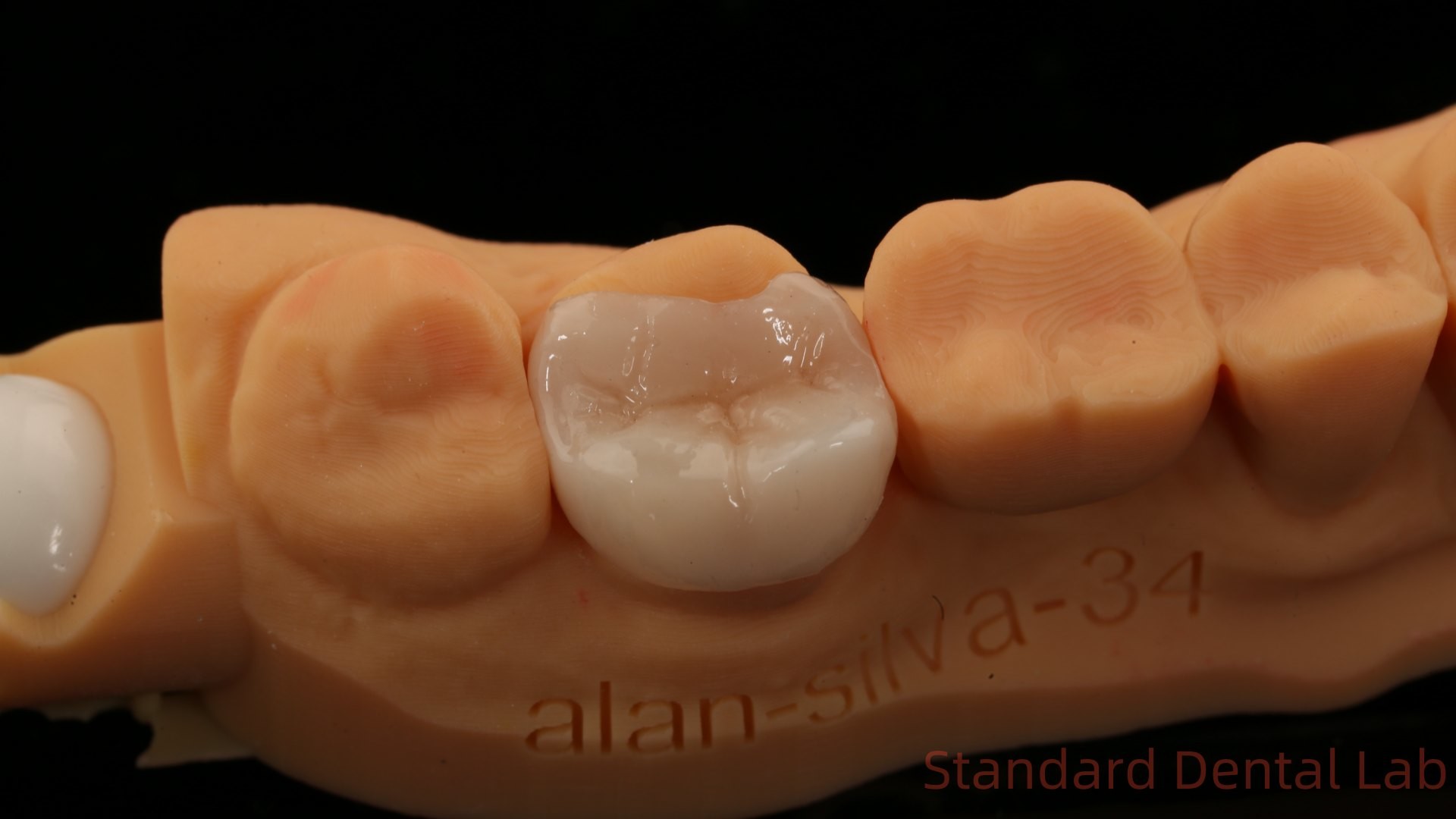 Translucency Dental Zirconia Crown Inlay Onlay Crown For Restore Natural Cavity Shape