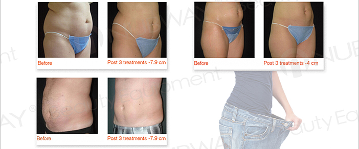 New product looking for distributor!!! CE approved high intensity focused ultrasound hifu for fat removal
