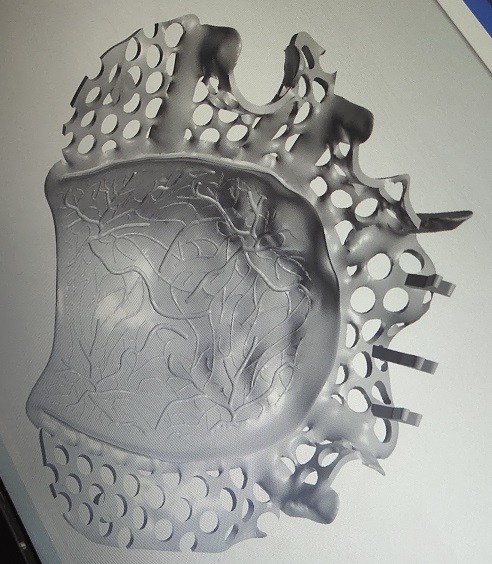 Removable 3D Printed Partial Denture Metal Framework