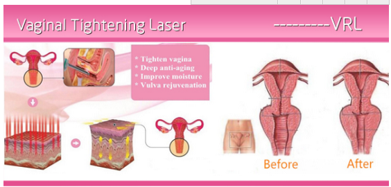 10600nm CO2 Laser Surgical System , Acne Scar Removal Laser Machine