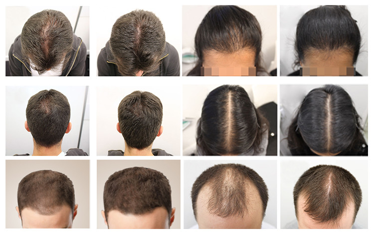Hair Growth 655 Nm Led Light Therapy Machine Hair Loss Lights Therapy Machine