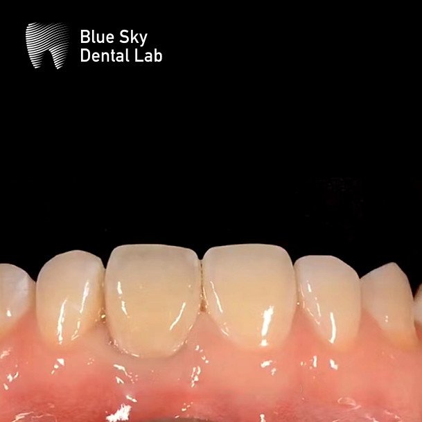 Hypoallergenic Dental Implant Zirconia Abutment Biocompatible